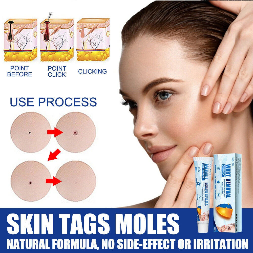 Skin Tag Removal Warts Remover Cream Herbal Ointment Face Body Tag Remover 20g