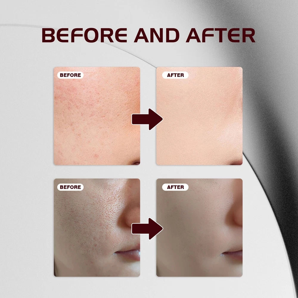 12% AHA BHA PHA LHA Peeling Solution Serum Brighen skin tone & Moisturise 30ml