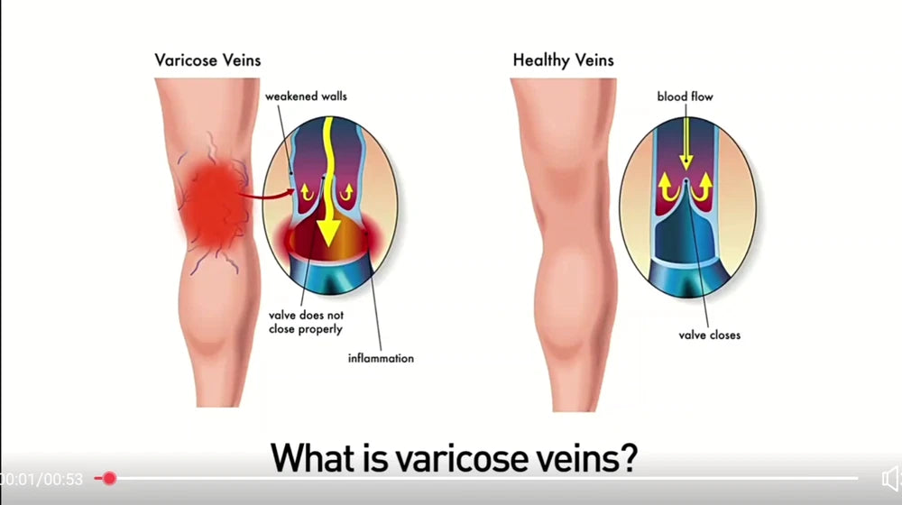 100%Original Vasculitis Blood Circulation Varicose Veins Treatment New Cream 20g