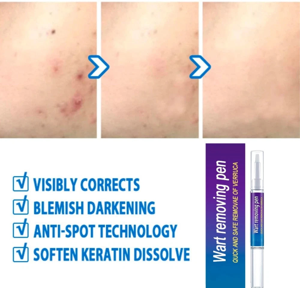 12 Hours Wart Remover Pen Skin Tag Mole Quick Remover Eliminate Foot Corn Warts