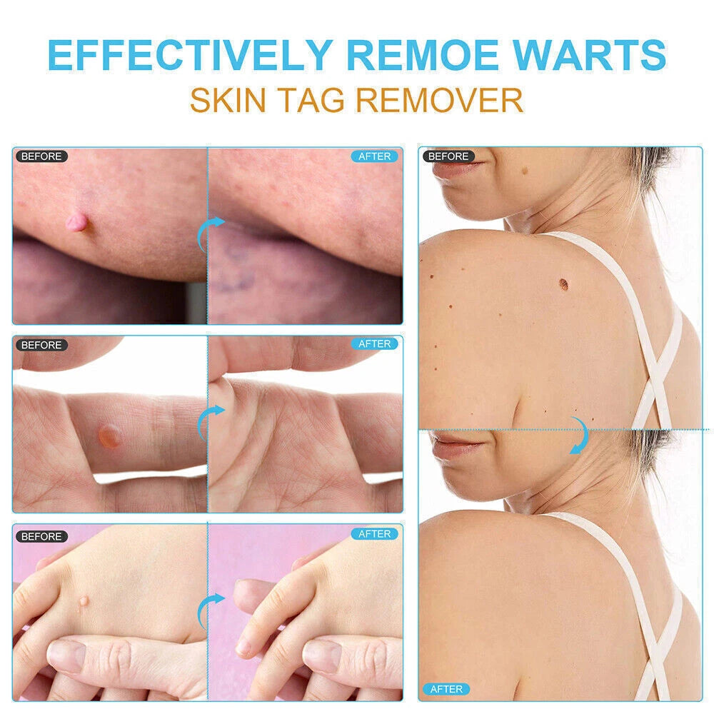 Wart Remover Liquid Skin Tag Mole Remover Eliminate Feet Corn Wart Removal〃