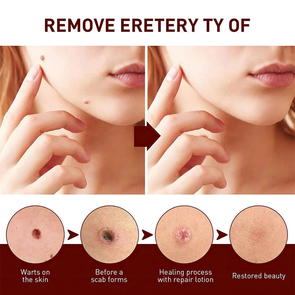 12 Hours Wart Remover Pen Skin Tag Mole Quick Remover Eliminate Foot Corn Warts