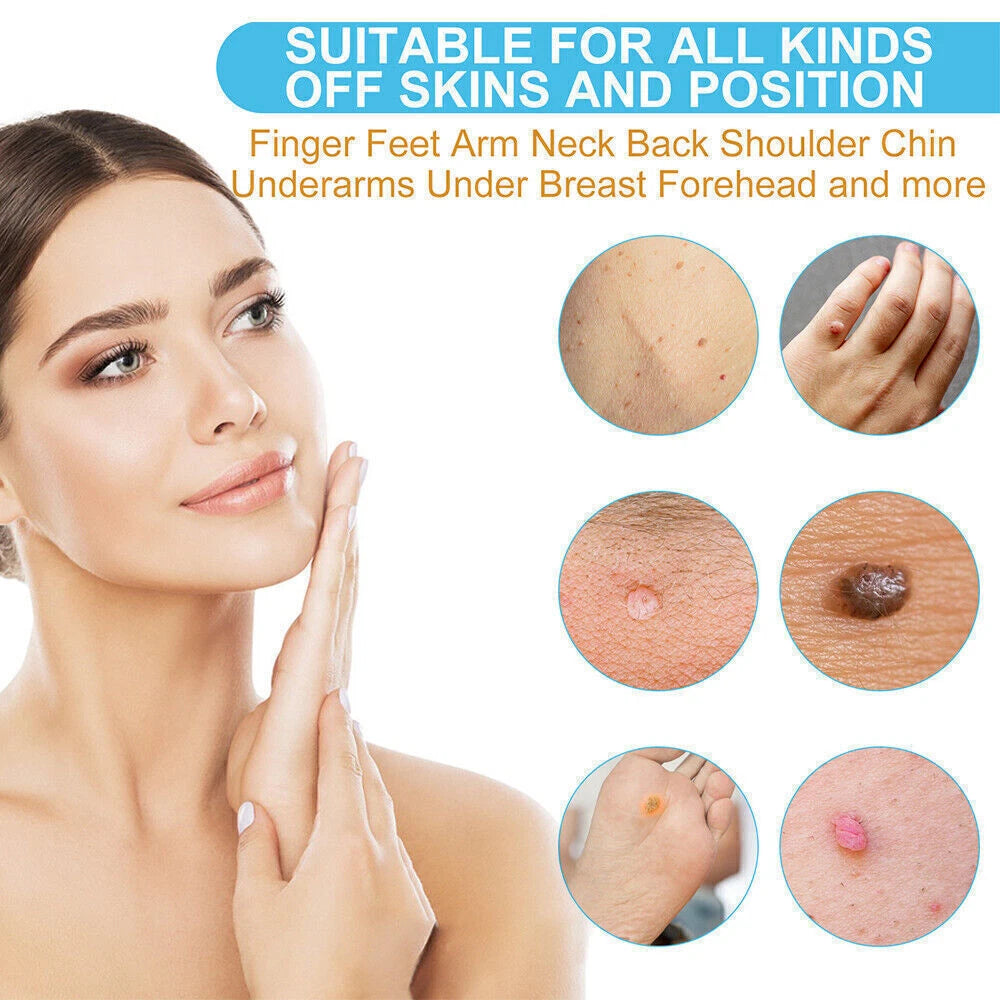 Wart Remover Liquid Skin Tag Mole Remover Eliminate Feet Corn Wart Removal〃