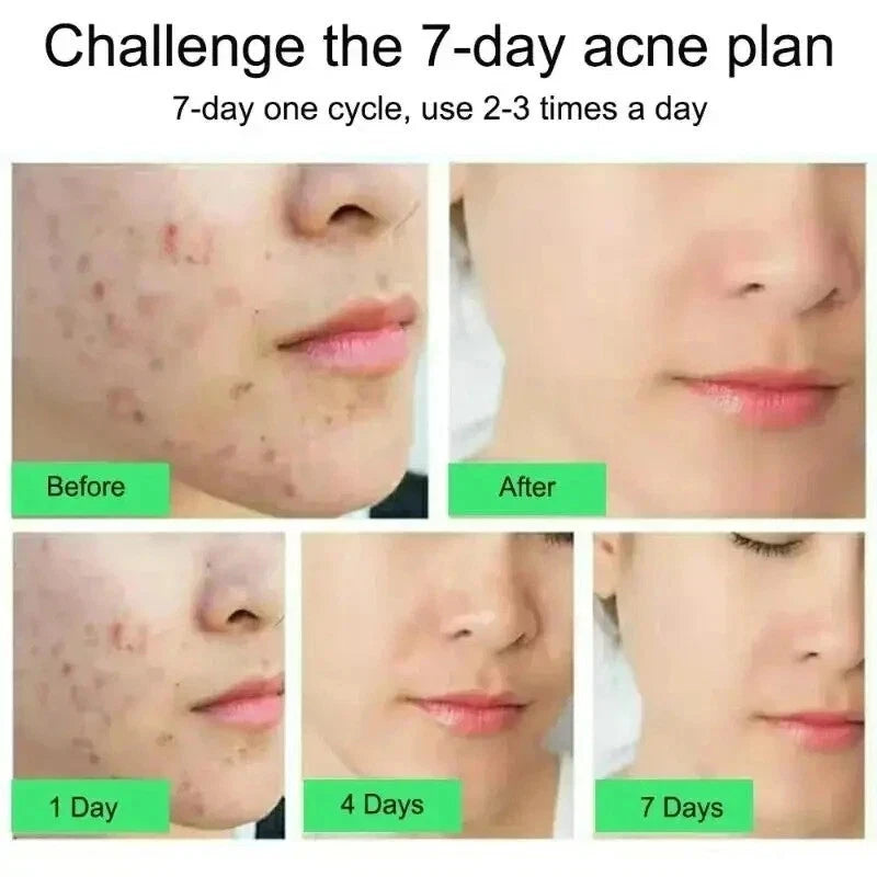 Salicylic Acid Strong Acne Removal Cream Anti Acne Pimple Scars Spots Clean Uk