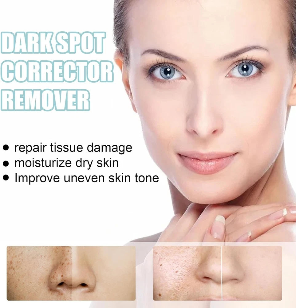 Dark Spot Remover for Face Age / Liver Spots Corrector Freckles & Skin Whitening