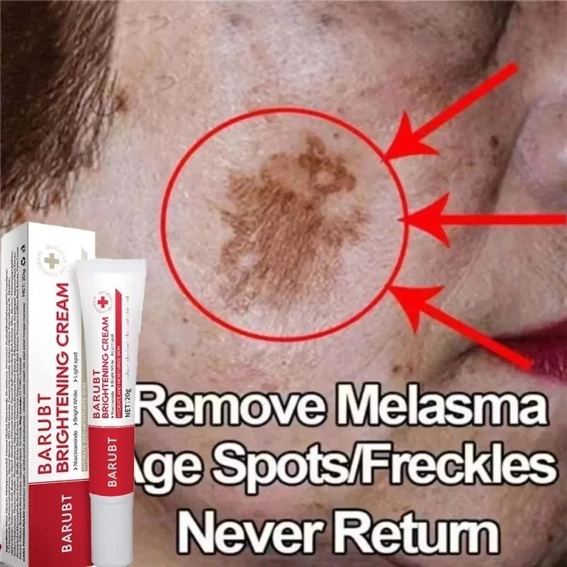 Melasma Treatment Dark Spots Cream Niacinamide Face Skin Brightening UK Seller