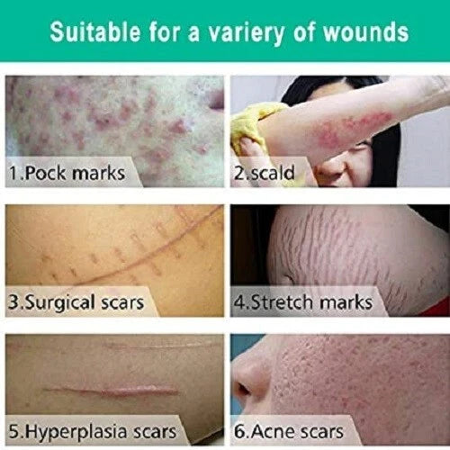 Scar Removal Cream New & Appearance of Old Scars Surgery, Stretch Marks, Acne,