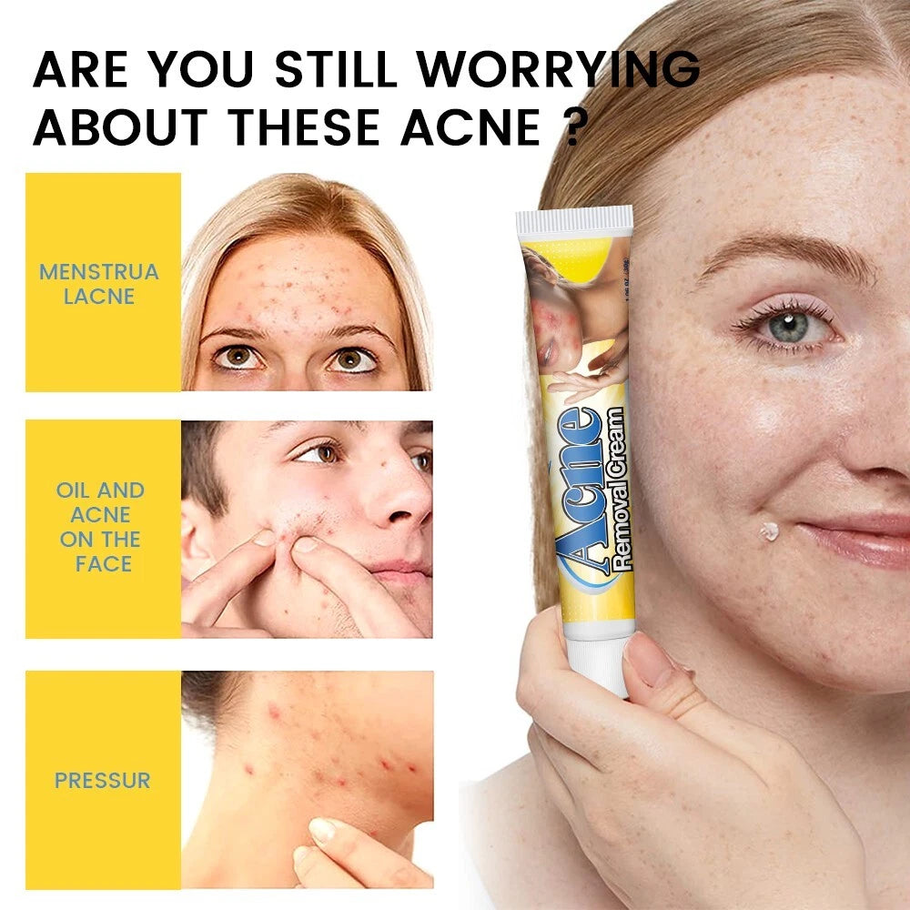 Acne Removal Cream Pimple Pits Pustule Ointment Deep Cleaning Face Repair Skin