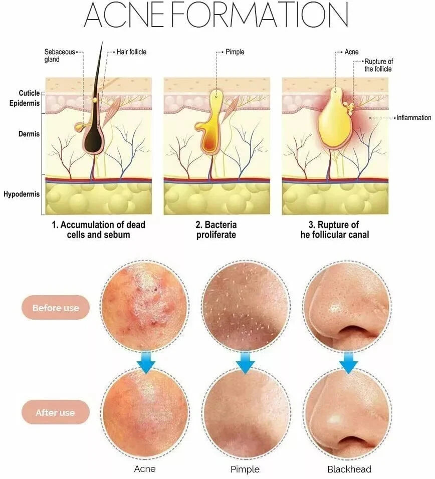 4x Blackhead Remover Tool Kit Spot Acne Pimple Comedone Extractor Popper Comedon