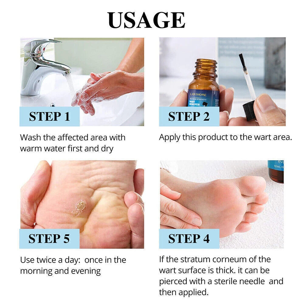 Wart Remover Liquid Skin Tag Mole Remover Eliminate Feet Corn Wart Removal〃