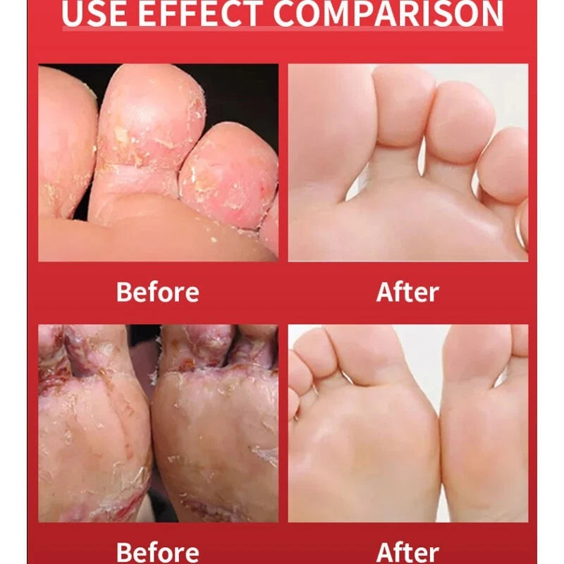 Beriberi Treat Athlete's Feet Ointment Foot Itching Anti-Fungal Peeling Tinea