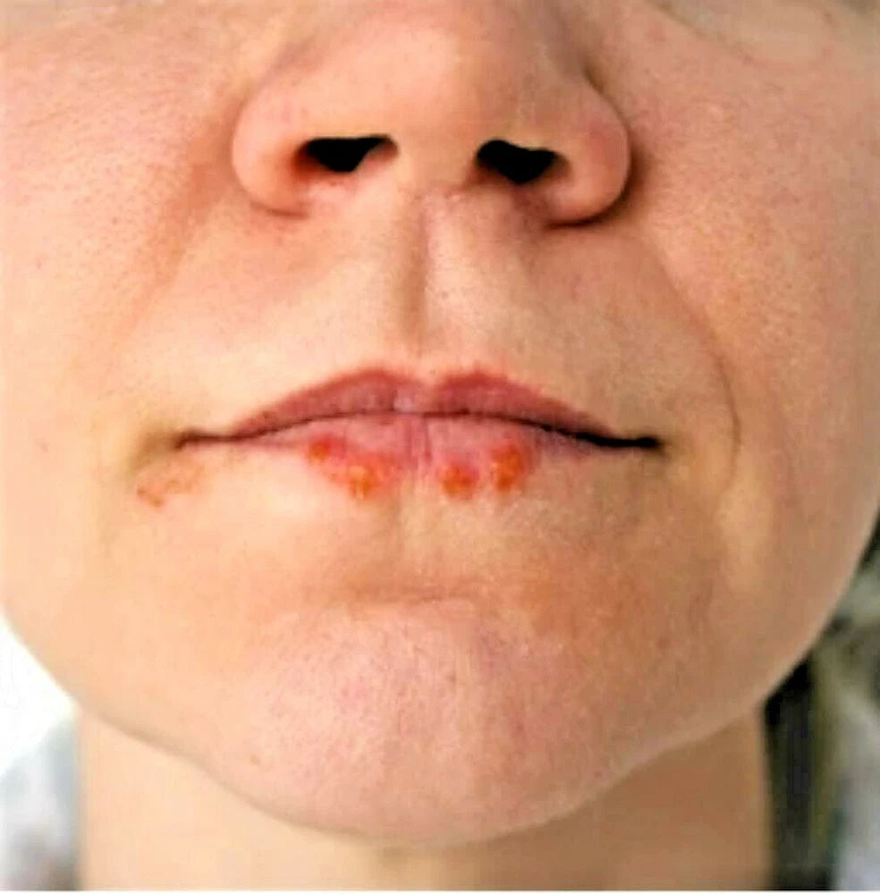 Tea Tree Cream for Acne Face & Skin Natural Antiseptic Balm 60ml 200ml UK Made