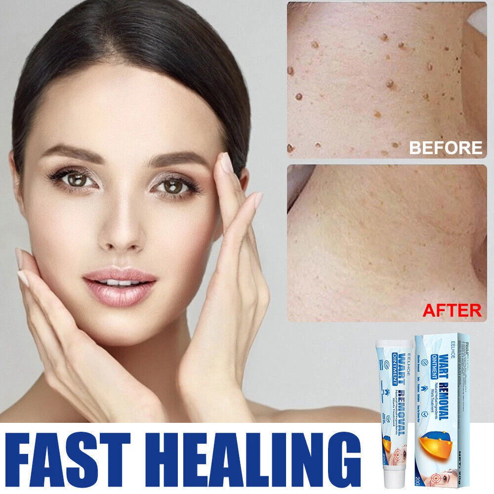 Skin Tag Removal Warts Remover Cream Herbal Ointment Face Body Tag Remover 20g
