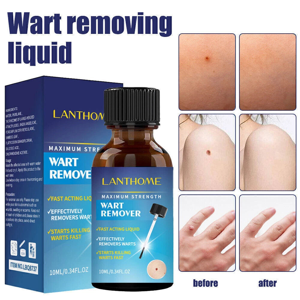Wart Remover Liquid Skin Tag Mole Remover Eliminate Feet Corn Wart Removal〃