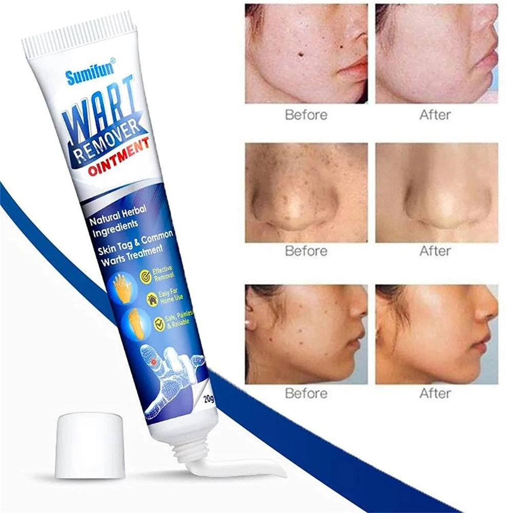 Wart Removal Treatment Cream Plantar Flat Filiform Periungual Common Skin Tag