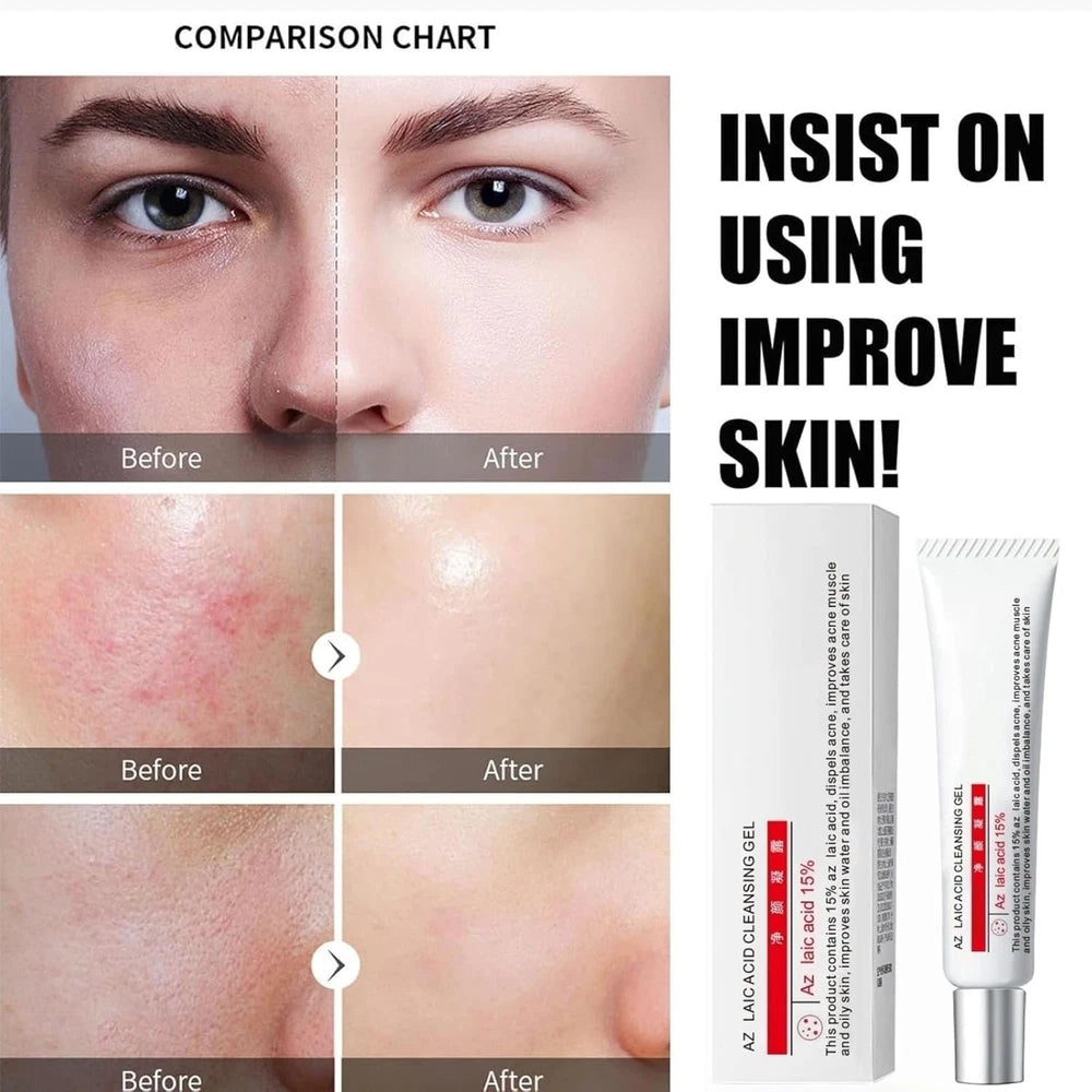 Aze-laic Acid 15% Acne Tratment Gel,15% Acid Acne Treatment Gel for Face,Azel-a