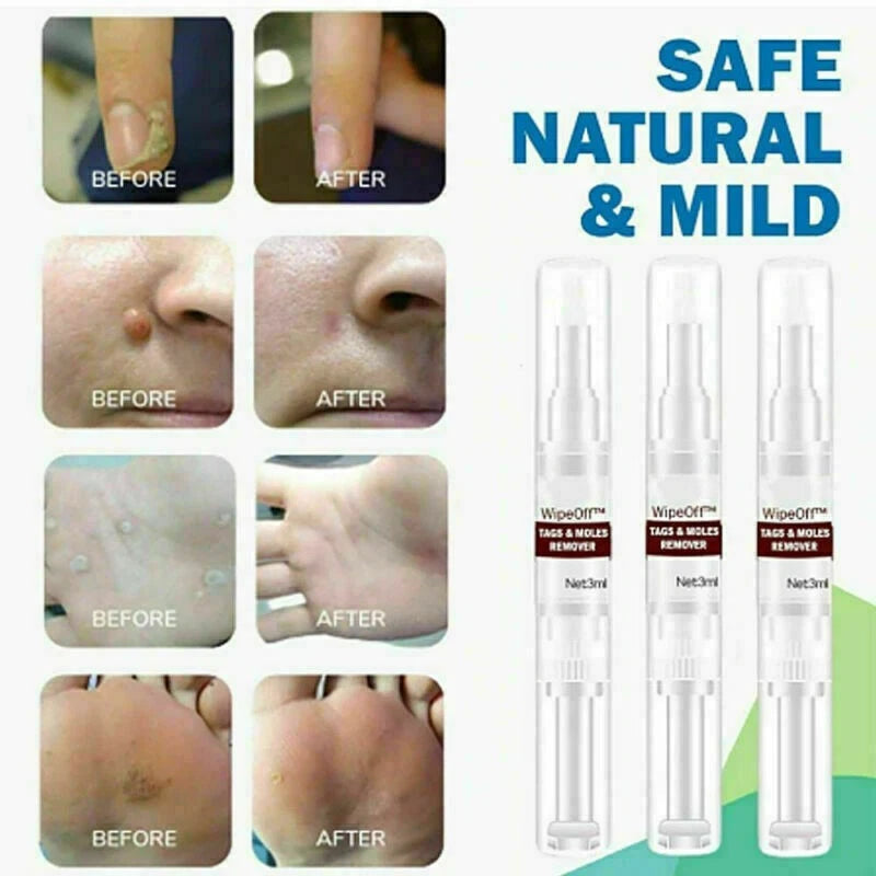 WipeOff™ Skin Tags & Moles Warts Corn Remover - Restore Skin Health and Beauty