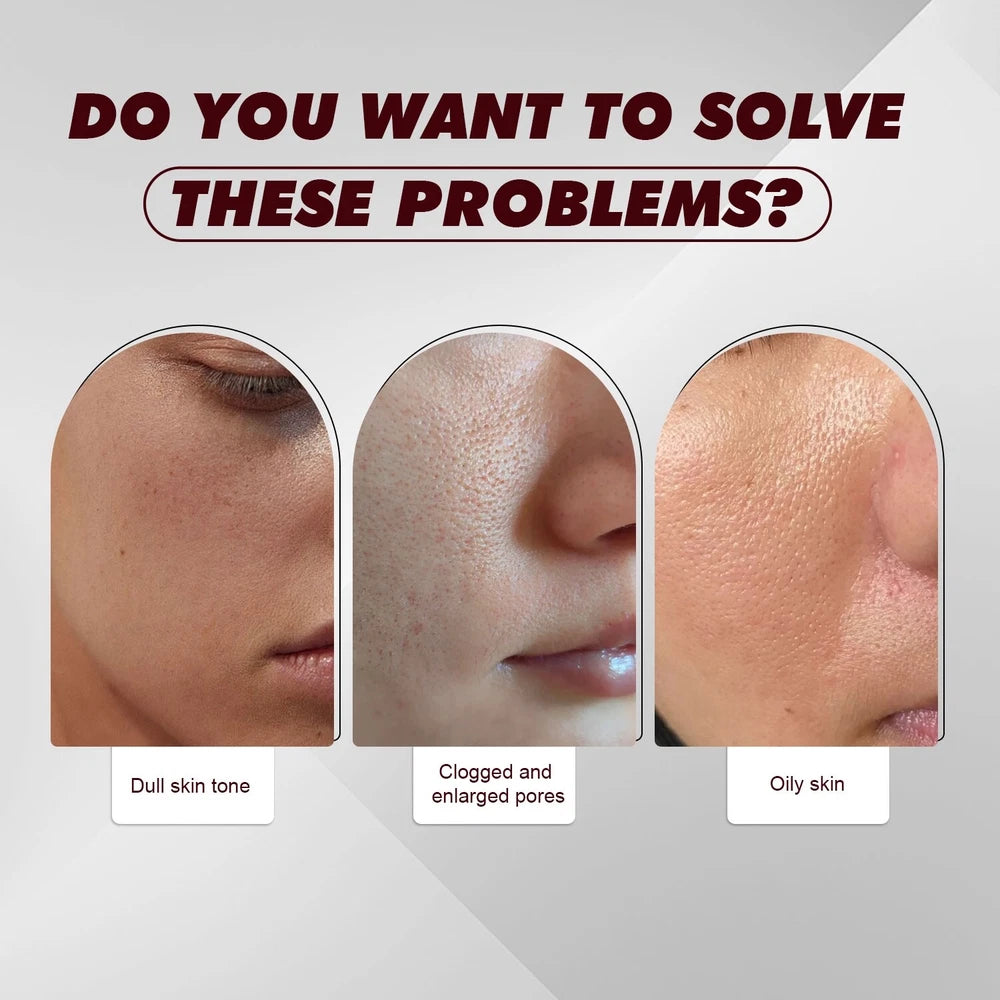 12% AHA BHA PHA LHA Peeling Solution Serum Brighen skin tone & Moisturise 30ml