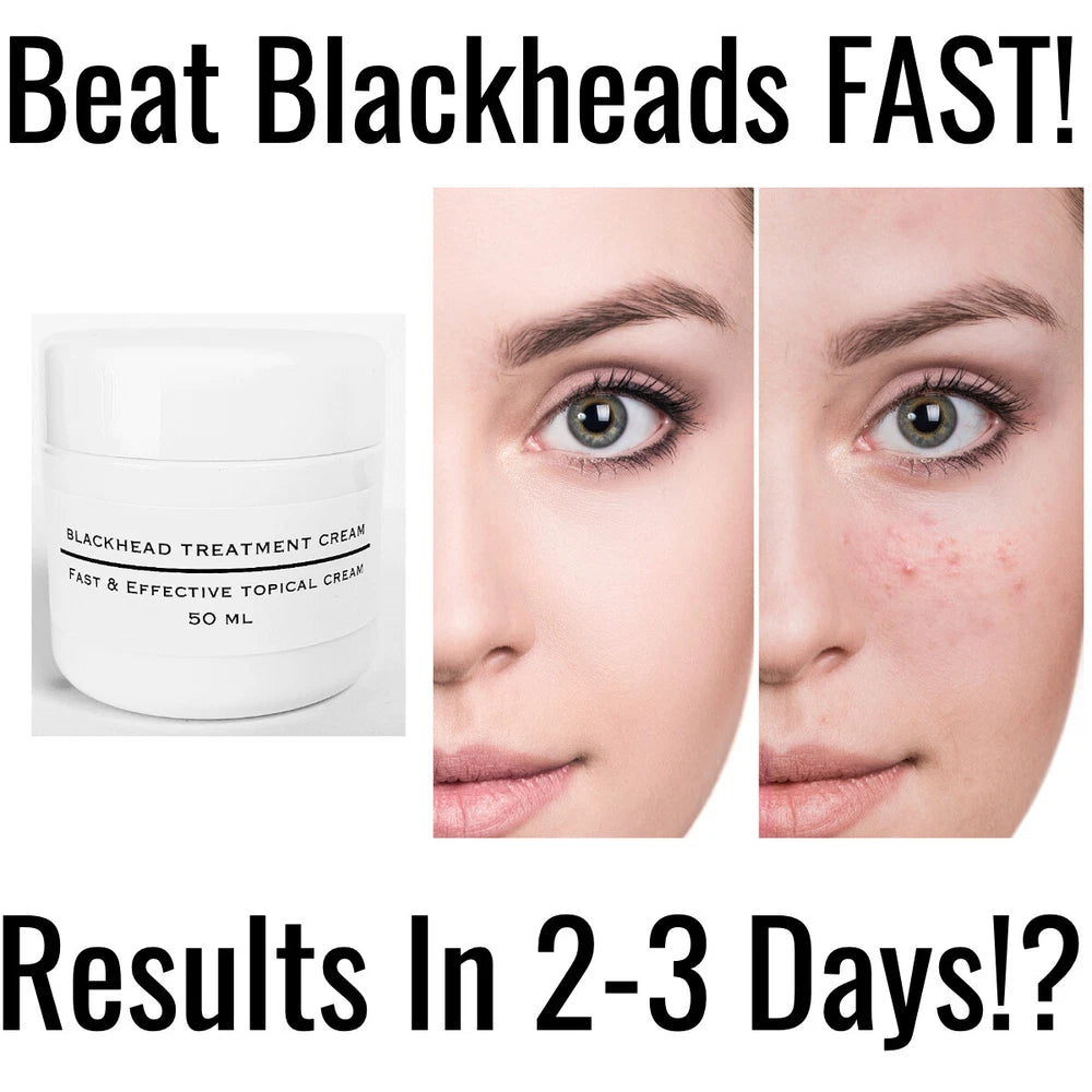Blackheads Cream Salicylic Acid Spots Acne Treatment Blemishes Bad Problem Skin