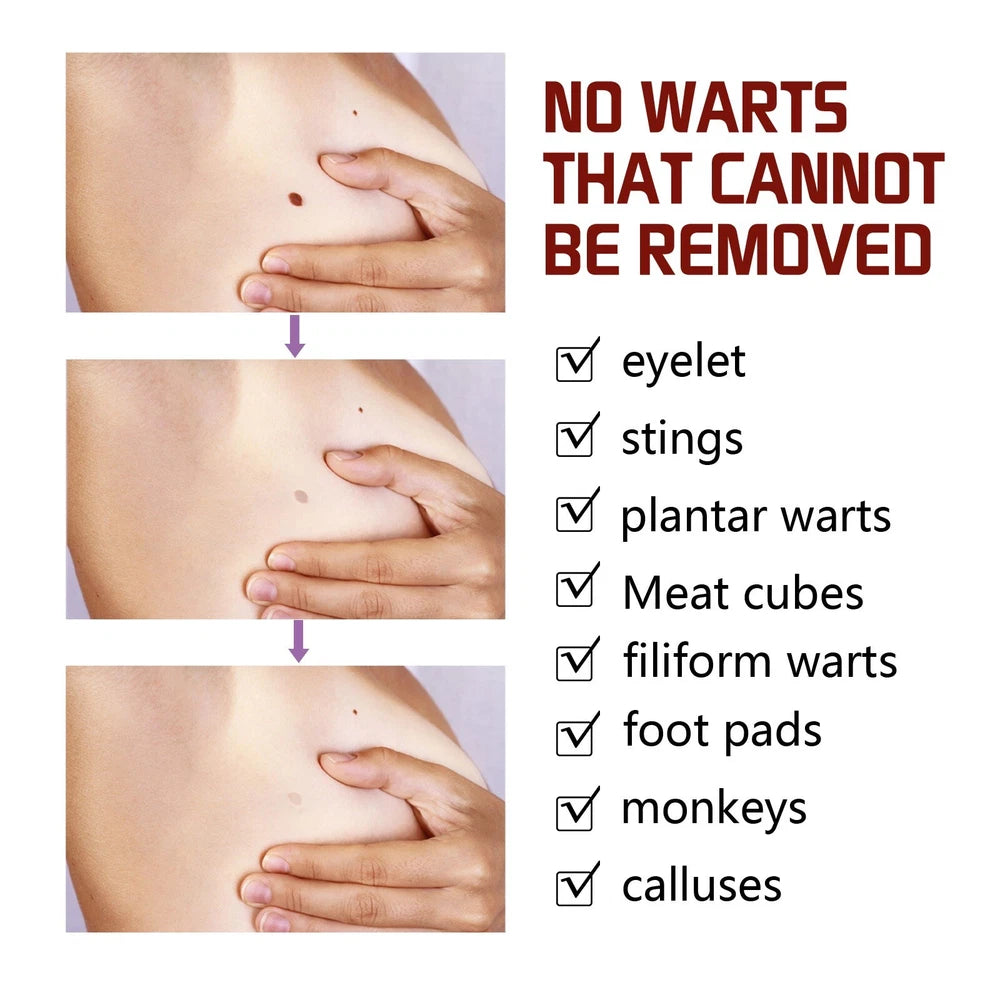 2PC 12 Hours Wart Remover Pen Skin Tag Mole Remover Eliminate Foot Corn Warts