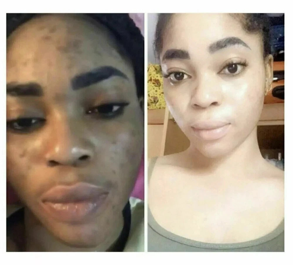 Dark Skin Bleaching Cream Whitening Lightening AHA - Face & Body |- 15g