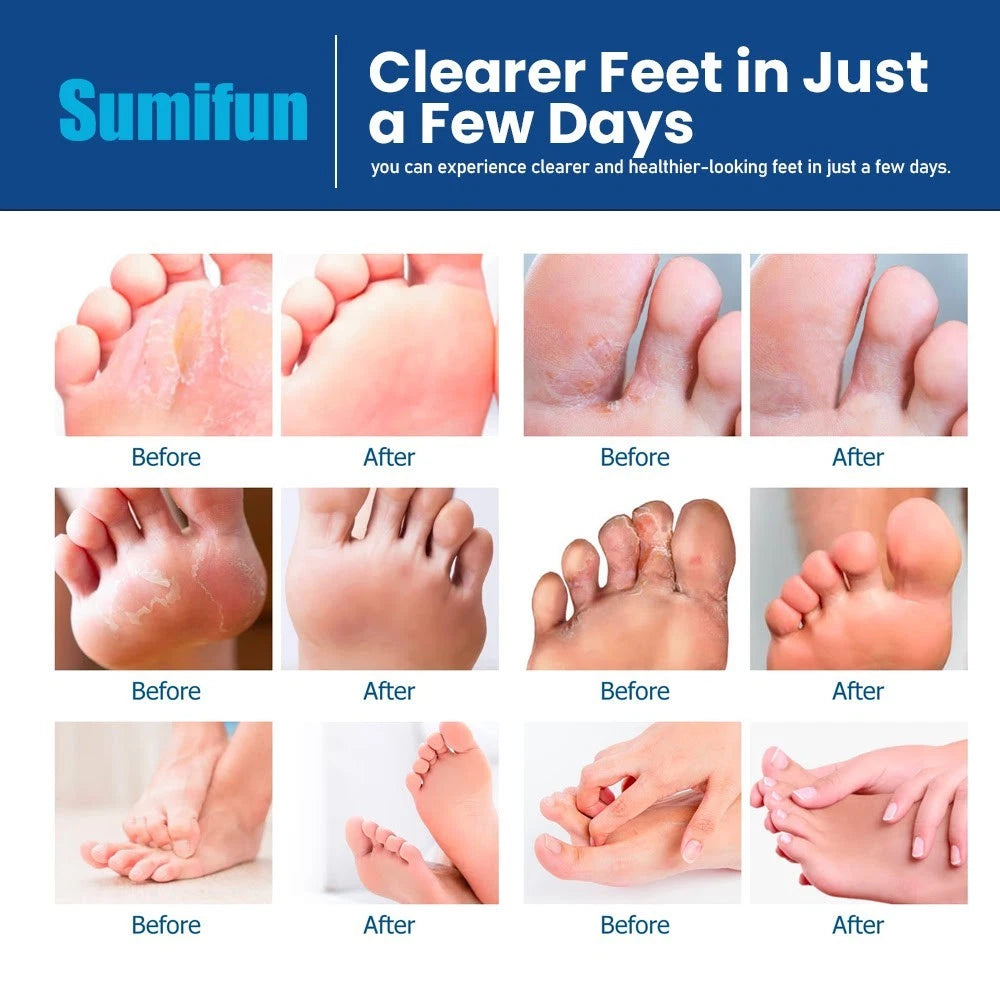 New Natural Nighttime Athlete's Foot 30g Cream Proven Cure Between Toes Lavender