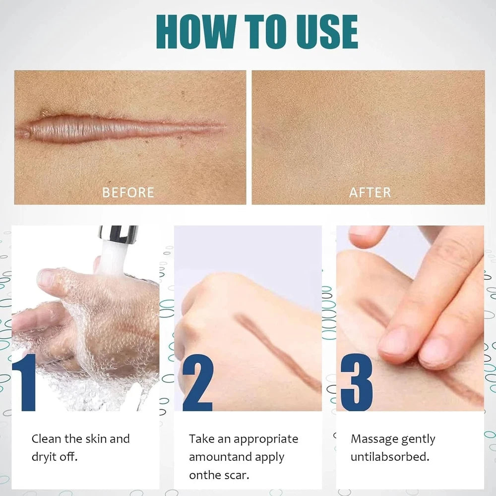Scar Removal Cream Silicone Gel for Old & New Scars Surgery Stretch Marks
