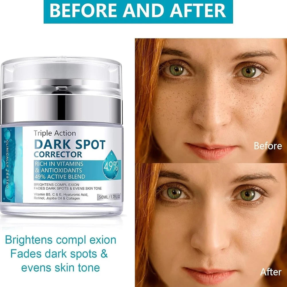 Hyperpigmentation Treatment Cream for Even Skin Tone - 50ml Dark Spot Remover