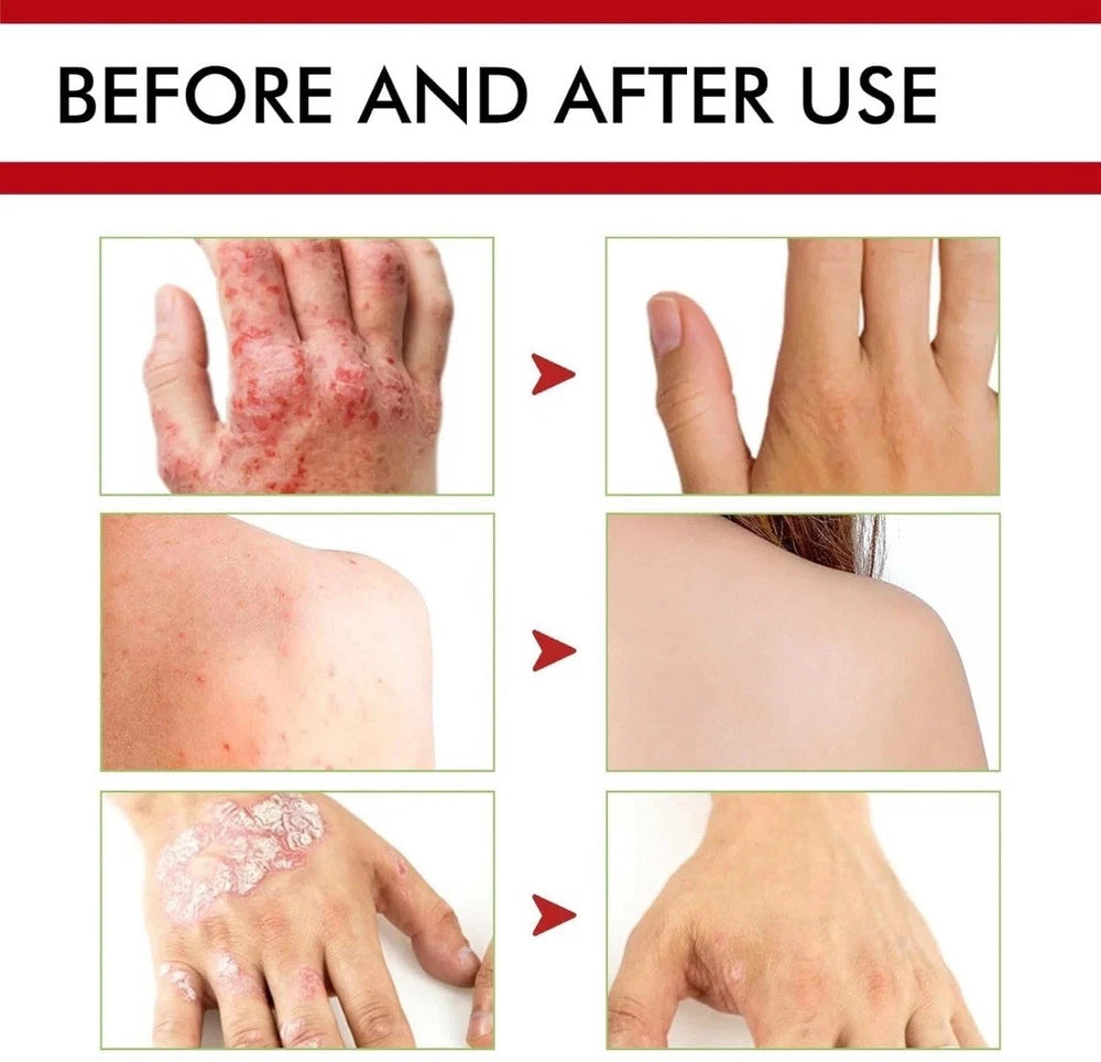 3pcs Antifungal Cream,Cream for Itchy Skin,Antifungal Cream for Skin,Itchy Skin