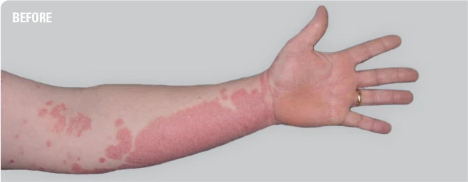 Salytar - 3% Salicylic Acid & 6% Coal Tar Ointment for Dry Skin Moisturizing 30g