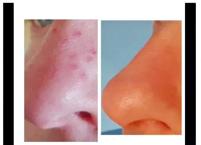 Vteen Salicylic Acid Spot Treatment Cream for Blackheads Milia Blemishes 30grams