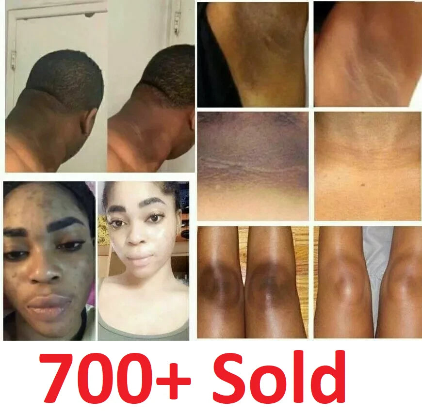 Dark Skin Bleaching Cream Whitening Lightening AHA - Face & Body |- 15g