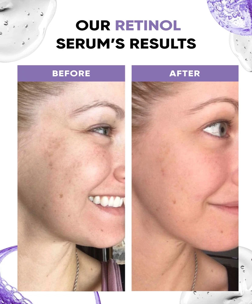 Pure Retinol Serum 0.25% with Hyaluronic Acid, Vitamin E & Natural Ingredients