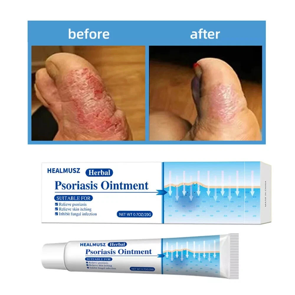 Natural Psoriasis Cream for Dermatitis Eczematoid Eczema Skin Ointment Treatment