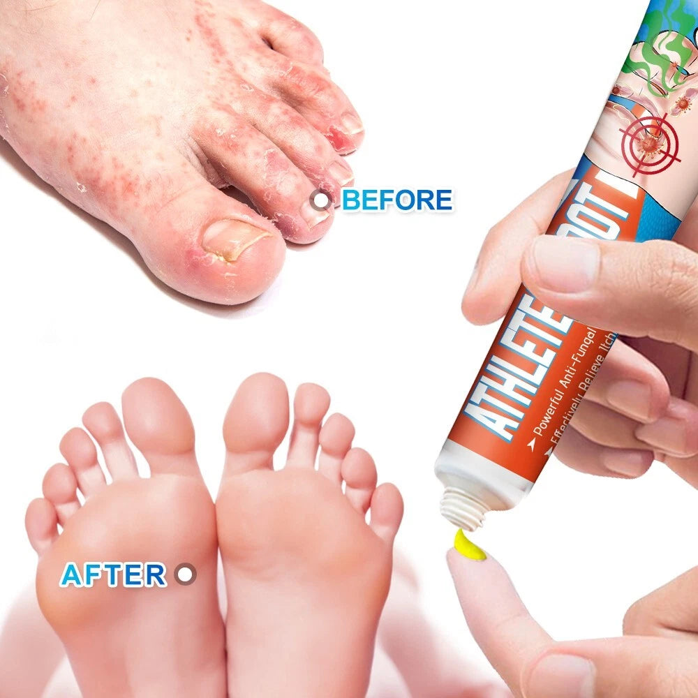 Beriberi Treat Athlete's Feet Ointment Foot Itching Anti-Fungal Peeling Tinea