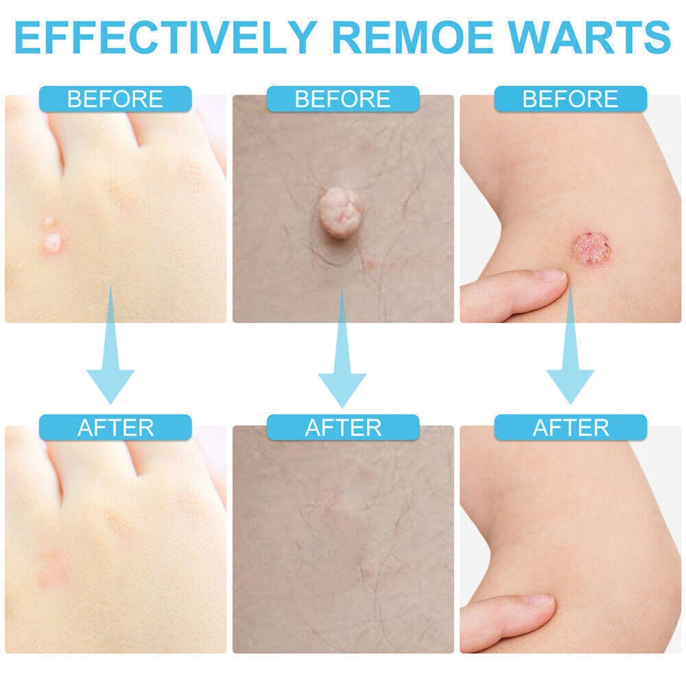 Wart Remover Liquid Skin Tag Mole Remover Eliminate Feet Corn Wart Removal〃