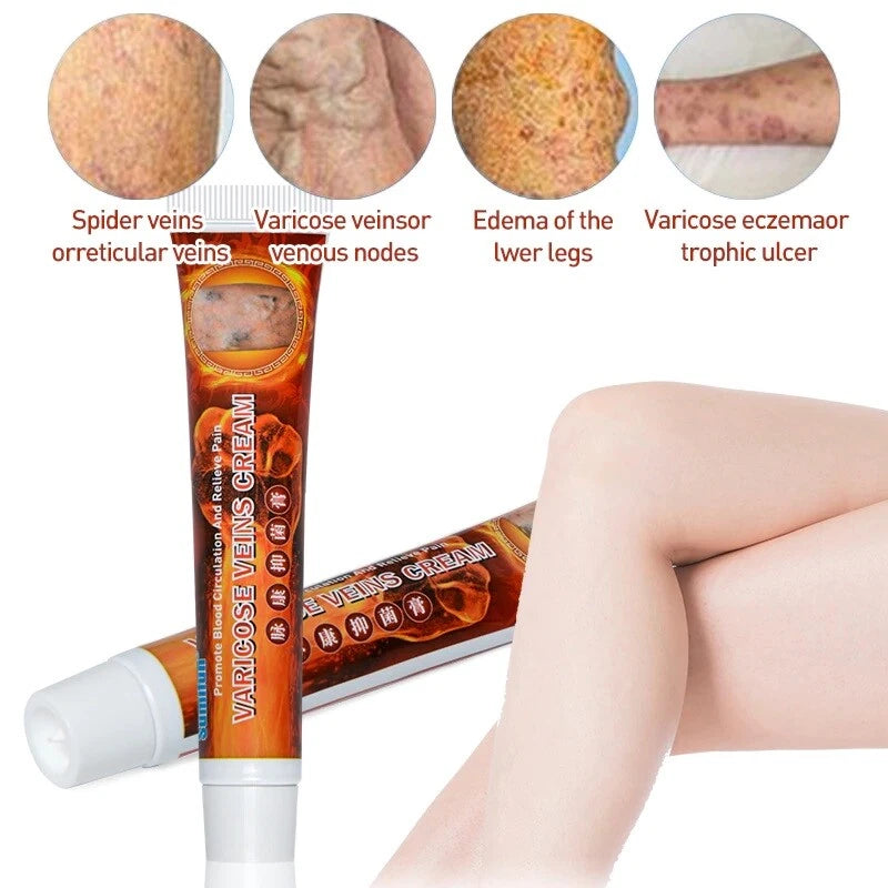 100%Original Vasculitis Blood Circulation Varicose Veins Treatment New Cream 20g