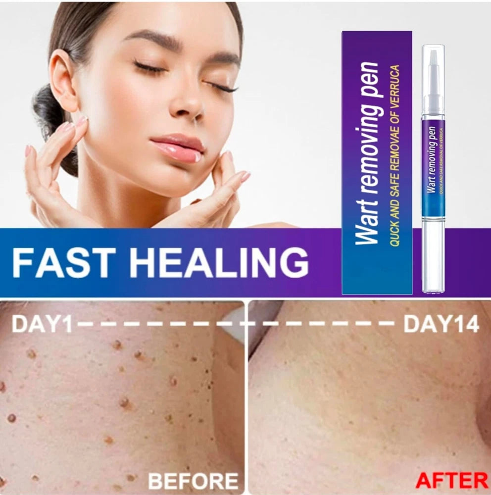 12 Hours Wart Remover Pen Skin Tag Mole Quick Remover Eliminate Foot Corn Warts