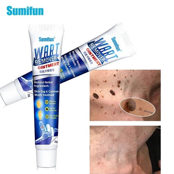 Wart Removal Treatment Cream Plantar Flat Filiform Periungual Common Skin Tag