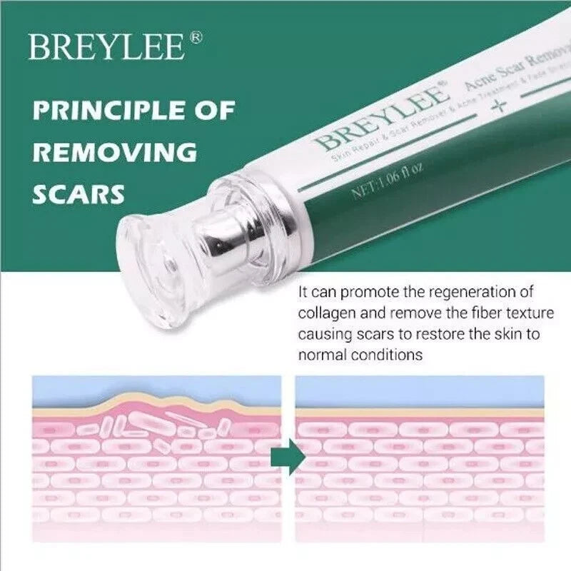 Breylee Acne Scar Removal Cream 30G Face Cream Skin Repair Skin Care Scar Acne