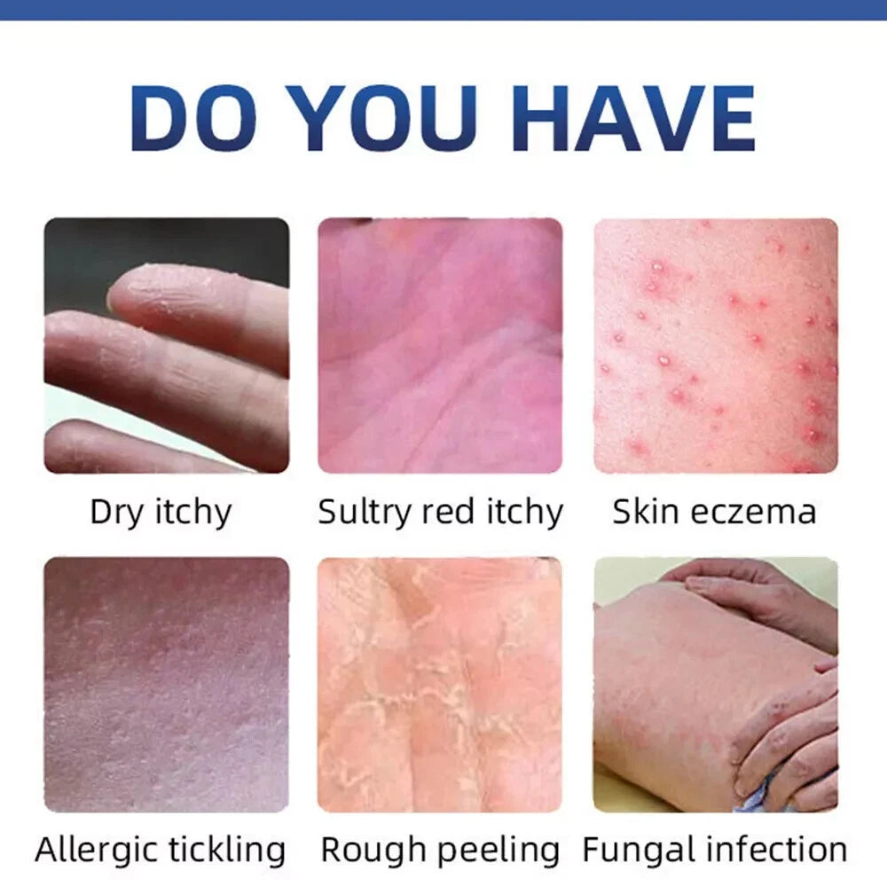 Natural Psoriasis Cream for Dermatitis Eczematoid Eczema Skin Ointment Treatment