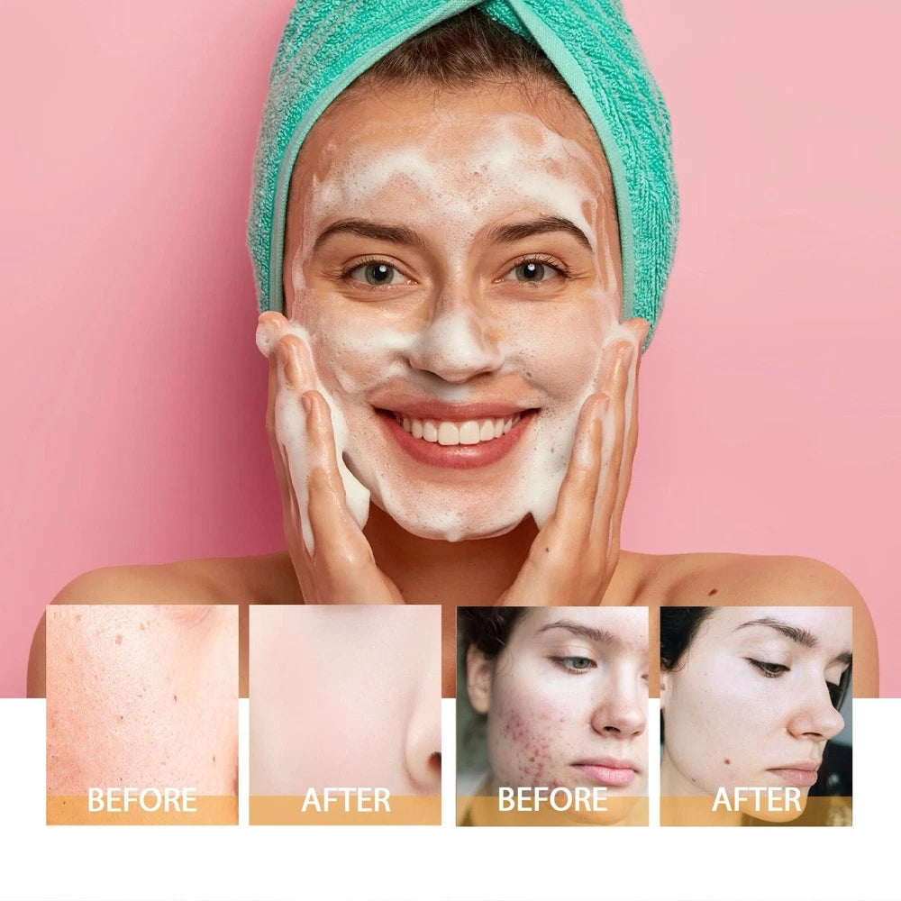 Turmeric Facial Cleanser Relief Acne Pimple Skin Brightening Foaming Face Wash