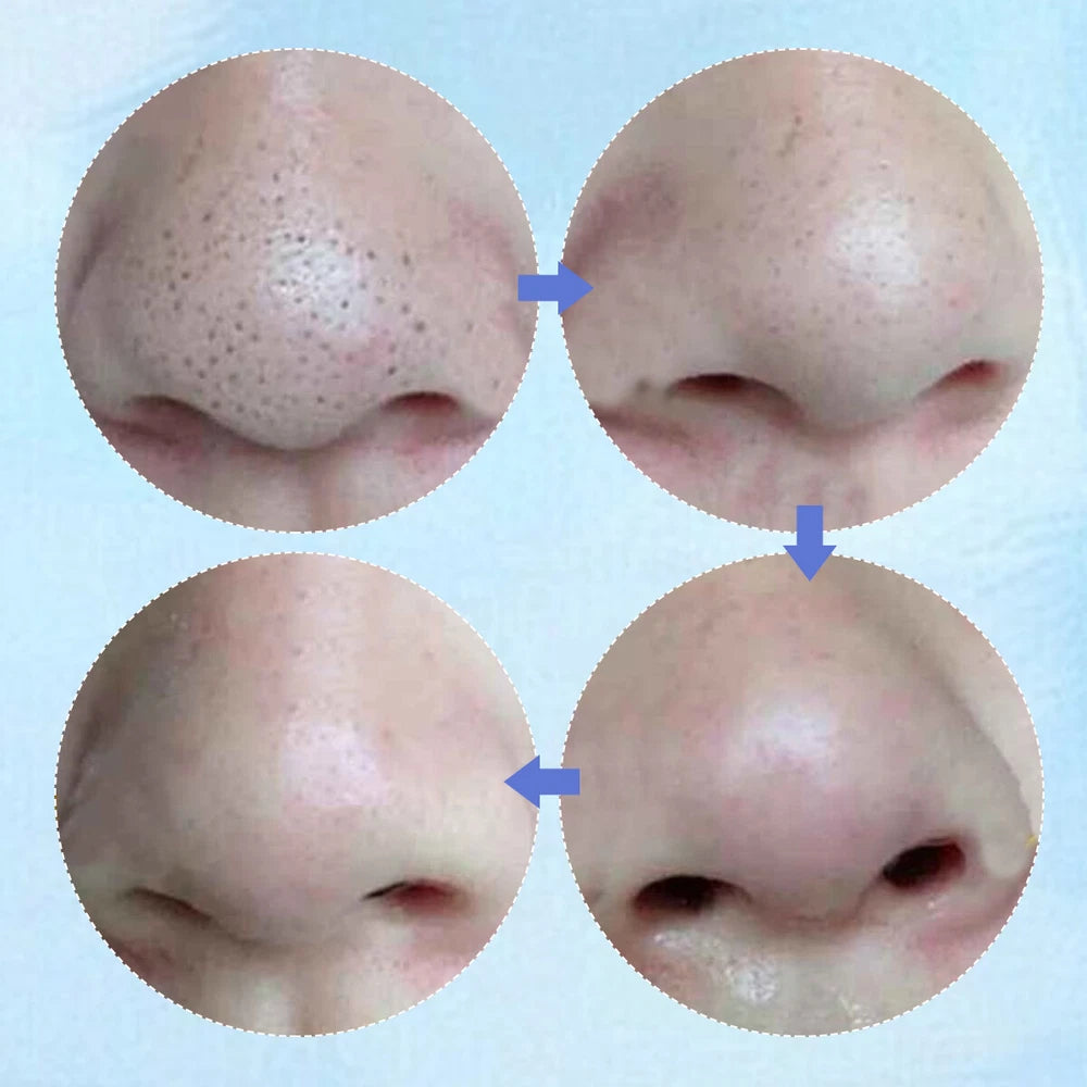 ✅10pcs Nose Pore Strips Blackhead Removal Unclog Pores Smooth Deep Cleansing NEW
