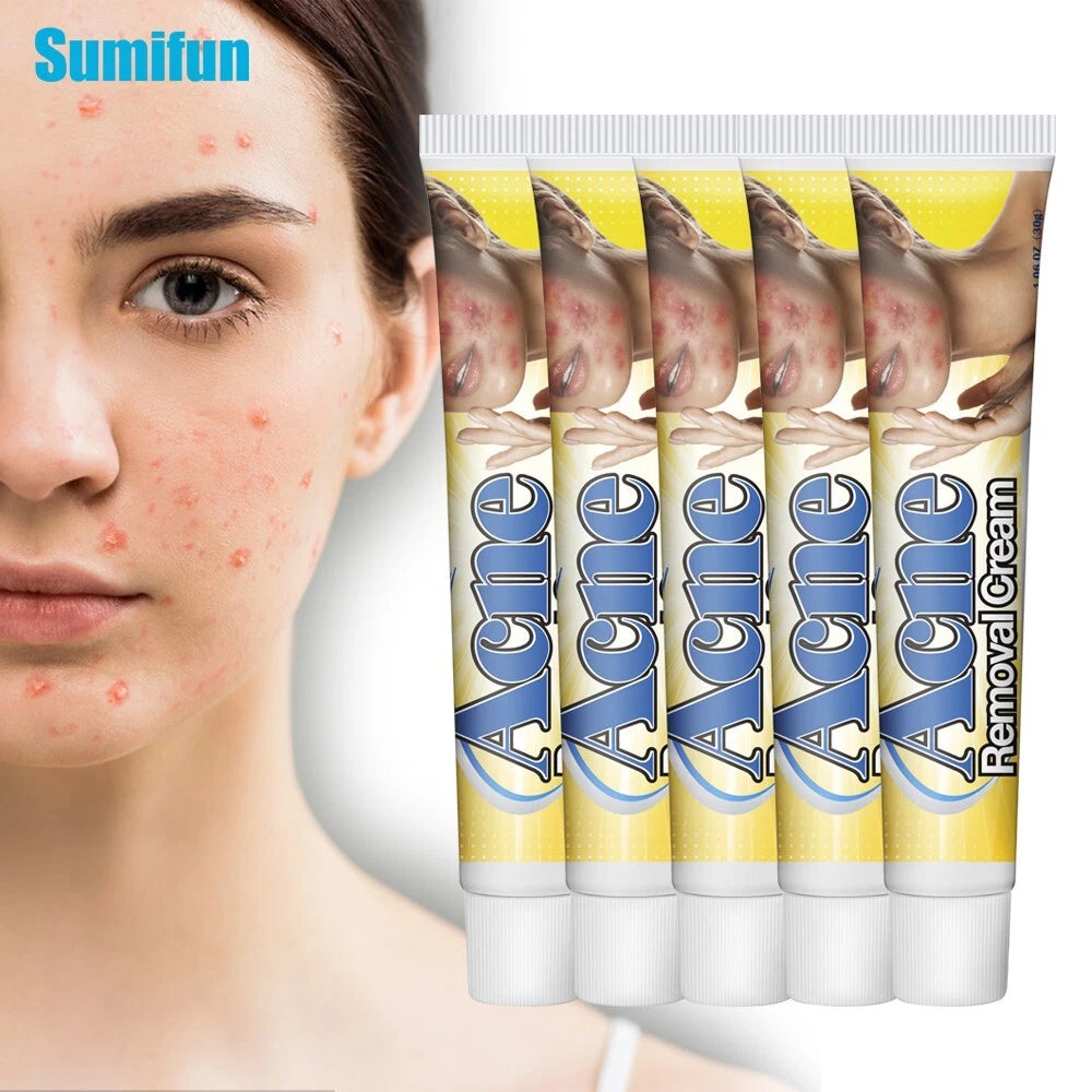 Acne Removal Cream Pimple Pits Pustule Ointment Deep Cleaning Face Repair Skin