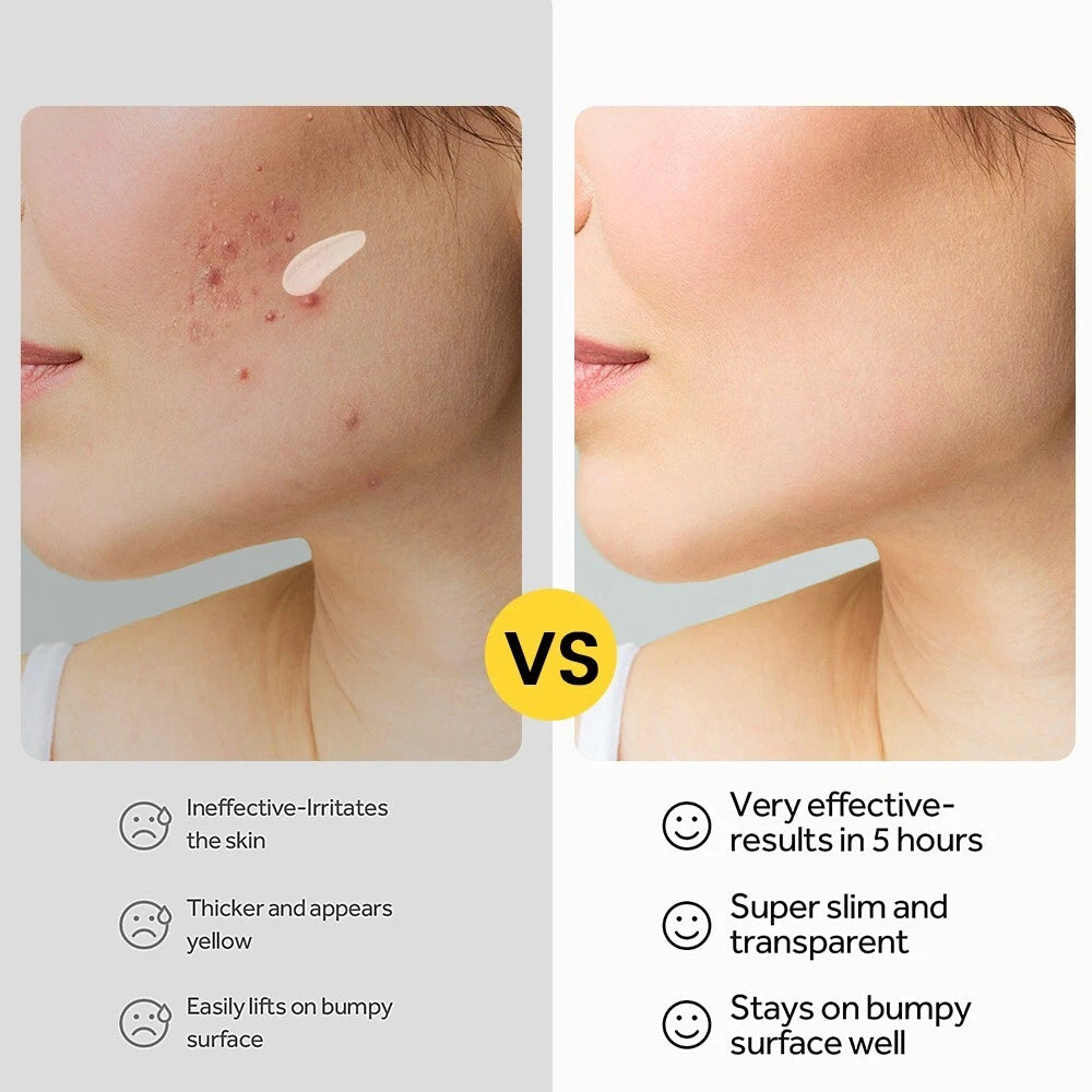 30g Acne Removal Cream Pimple Pits Pustule Deep Cleaning Face Repair Skin