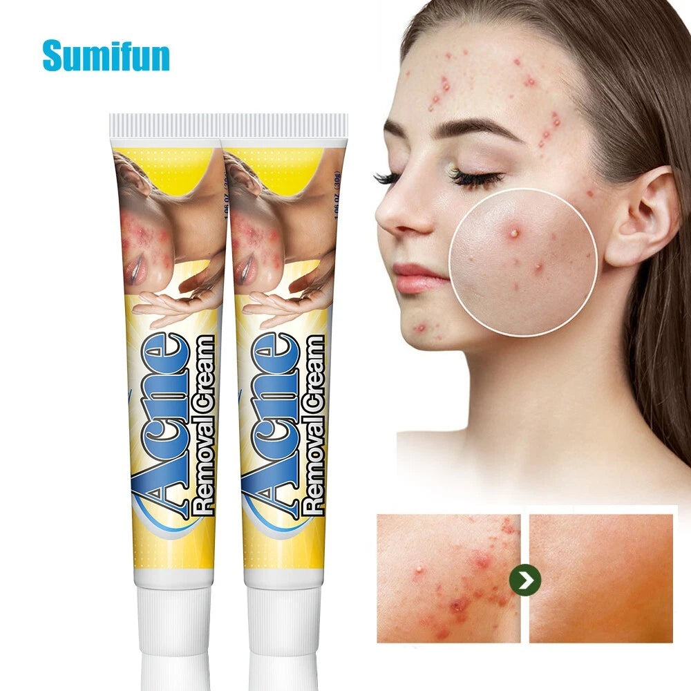 Acne Removal Cream Pimple Pits Pustule Ointment Deep Cleaning Face Repair Skin