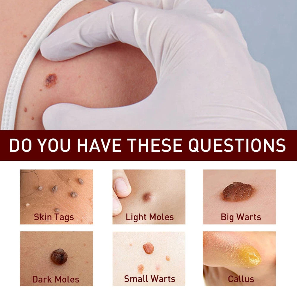 2PC 12 Hours Wart Remover Pen Skin Tag Mole Remover Eliminate Foot Corn Warts