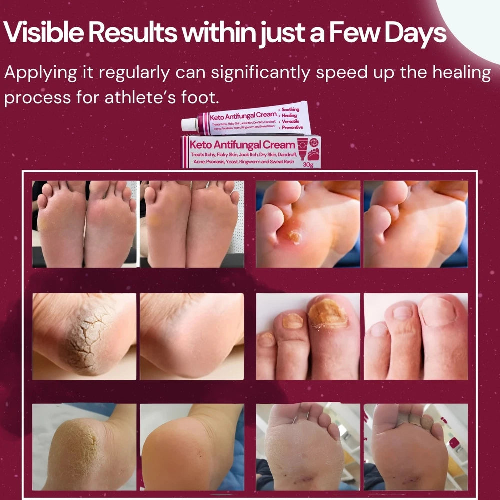 Antifungal Cream Relief from Jock Itch, Athletes Foot, Psoriasis, Ringworm, Acne