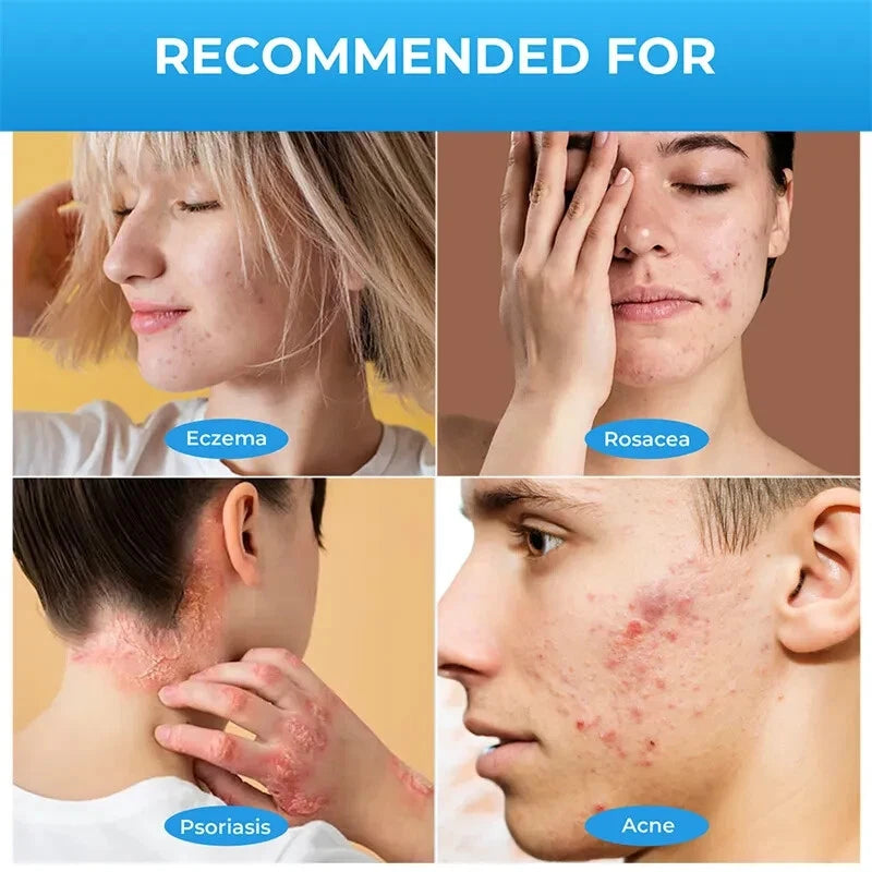 20g New Rosacea Ointment Treat Red Nose Acne Cream Pimple Scar Repair Skin Care