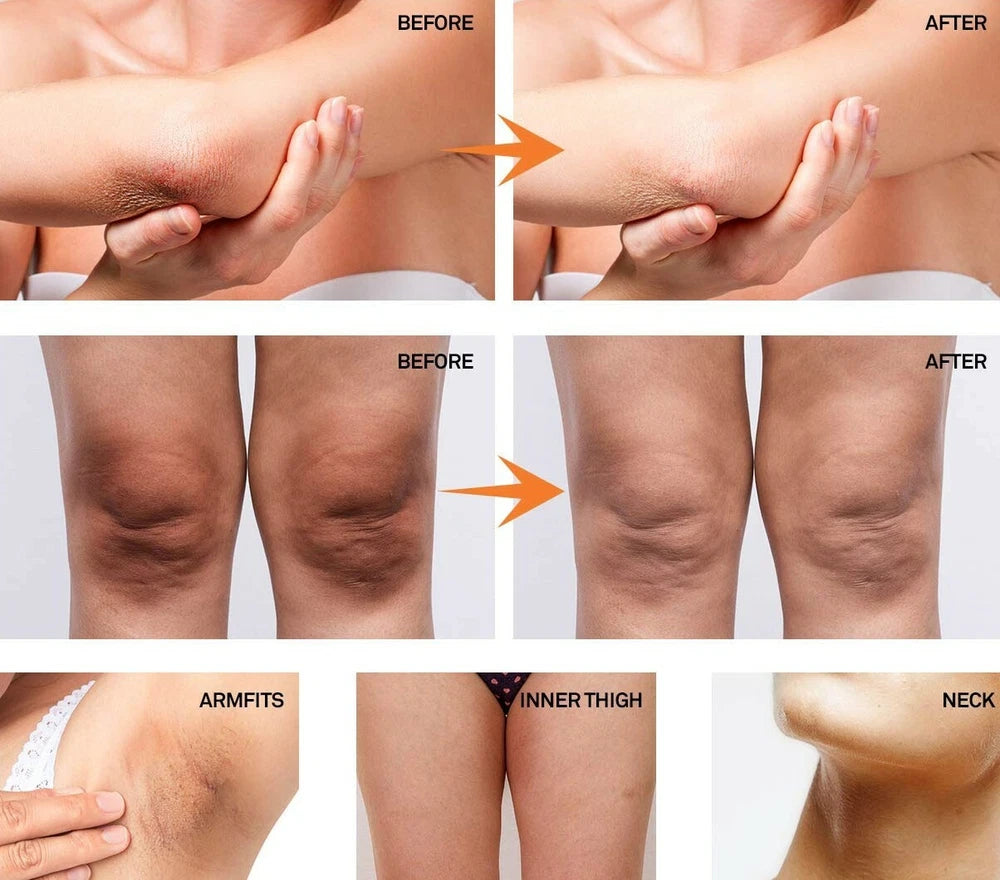 Intimate Skin Whitening Gel Lightening Body Bleach Cream, Vaginal/Anal Bleaching